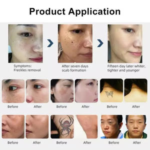 Máquina de Cuidado Personal Faling a Pico 1064 532 1320 nm para Eliminar Tatuajes, Cejas, Cicatrices, Pigmentación, Limpiador Facial para Uso Doméstico - Product Image 6