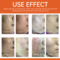 Crème anti-acné Calantha à action rapide et efficace avec AHA et Niacinamide, soin hydratant pour la peau, resserre les pores, contrôle le sébum et combat les boutons