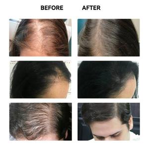 Suero de ampolla nutritiva para el crecimiento del cabello de 5ml para el cuero cabelludo - Product Image 5