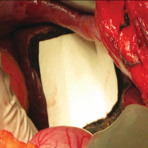 ผ้ากอซหยุดเลือดผ่าตัดทางการแพทย์แบบใช้แล้วทิ้งอย่างรวดเร็วปลอดภัย ผ้ากอซหยุดเลือดกันน้ํา ผ้ากอซดูดซับระบายอากาศได้ - Product Image 2