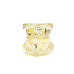 Modèles de prothèses dentaires, modèles dentaires détachables, modèles de restauration d'implants, enseignement intuitif. - Product Image 1