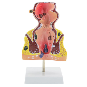 Modèle anatomique pathologique rectal en PVC pour la démonstration pédagogique en sciences médicales dans les universités médicales et les hôpitaux - Product Image 1