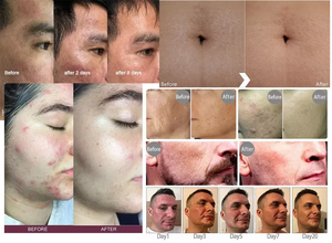 Machine professionnelle de soin du corps du visage de beauté de retrait de cicatrice de xel thermique de ti avec la poignée 2 - Product Image 6