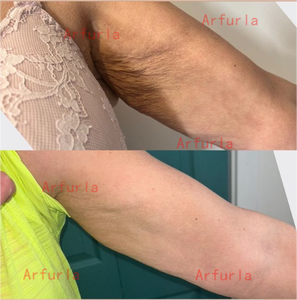 Máquina de Lipólisis con Resultados Efectivos, 980nm 1470nm, Máquina Endoláser de Alta Potencia, Lifting Facial, Lipólisis Láser, Máquina de Liposucción - Product Image 5
