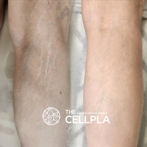 Cellpla 细胞血浆机 去除妊娠纹 去除脂肪团 去除疤痕 - Product Image 6