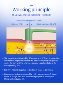 Micro-sculpture Peninsula Gold à bas prix, dissolution des graisses, remodelage du corps, rajeunissement du visage, resserrement de la peau, fonte des graisses - Product Image 3