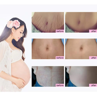 Crème anti-vergetures à la mangue la plus vendue, marque privée, réparation post-grossesse, cicatrices, ligne abdominale, vergetures, crème personnalisée