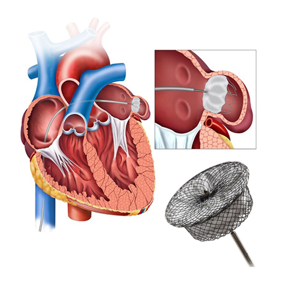 Low-Profile Atrial Disk Nitinol Mesh for Minimized Thrombosis Risk