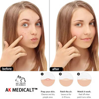 Patch d'acné étoile Laser à l'acide salicylique de marque privée Patch d'acné auto-dissolvant Patch holographique pour bouton pour les soins de la peau