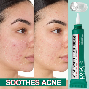 Crème anti-acné OEM de haute qualité : Réduit les éruptions cutanées, soulage les rougeurs, retient l'hydratation, action rapide, éclaircit les taches brunes - Product Image 3