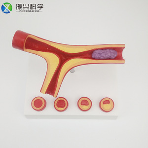 Modelo de arteria en forma de Y con aterosclerosis y trombosis, modelo educativo, suministros del fabricante. - Product Image 5