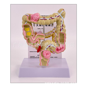 Modèle de simulation pédagogique de la pathologie du côlon, spécimen de lésion colorectale, communication médecin-patient sur les intestins, organe humain - Product Image 4