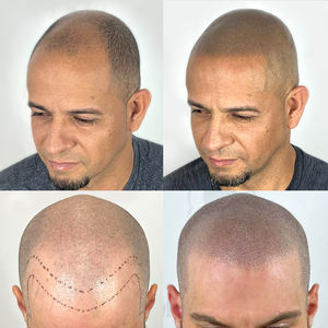 Kit de machine à tatouer Smp OEM fournitures de micropigmentation du <span class=keywords><strong>cuir</strong></span> <span class=keywords><strong>chevelu</strong></span> personnalisées Offre Spéciale de délié pour hommes en corée stylo de <span class=keywords><strong>tatouage</strong></span> de cheveux - Product Image 3