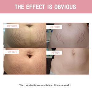 Crema Reafirmante para el Abdomen <span class=keywords><strong>de</strong></span> 100 ml, Reafirmante <span class=keywords><strong>de</strong></span> la Piel, Anti Estrías, Hidratante, Reafirmante para el Vientre, Crema para Estrías - Product Image 3