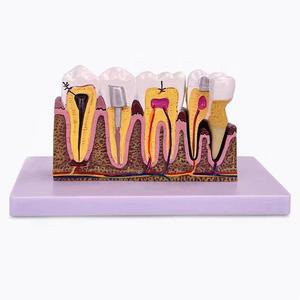 Modèle de caries dentaires pathologiques, modèle pédagogique complet de pathologie dentaire, modèle anatomique du dôme dentaire - Product Image 1
