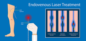 Proctology Endolaser Evlt rimozione vena ragno liposuzione diodo Laser 980 1470nm irradiazione laser endovenosa del sangue - Product Image 6