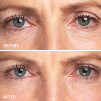 Patchs de masque pour les yeux en hydrocolloïde à micro-aiguilles, raffermissants, anti-rides, à base de vitamine C, de rétinol et d'acide hyaluronique