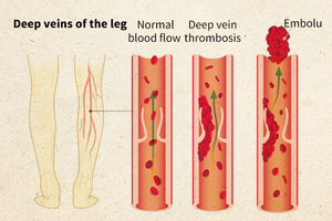 New Products V.ein Repair Patch for V.aricose V.eins Patch <strong>Blood</strong> V.essels in the Legs - Product Image 4
