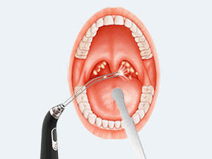 Appareil électrique portable en ABS pour l'élimination des calculs amygdaliens – Outil de soin de santé pour un nettoyage efficace à domicile et à usage commercial - Product Image 4