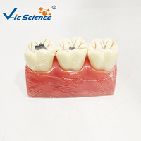 Modelo de Caries Dental de 3 Etapas, Ampliado 5 Veces, Dientes Desmontables para Educación en Patología Oral, CE ISO ROHS CNAS