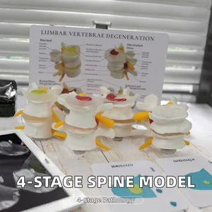 Modelo de Comparación de Degeneración de Vértebras Lumbares en 4 Etapas, Modelo de Anatomía de Columna Vertebral <span class=keywords><strong>con</strong></span> Gráfico Anatómico - Product Image 5