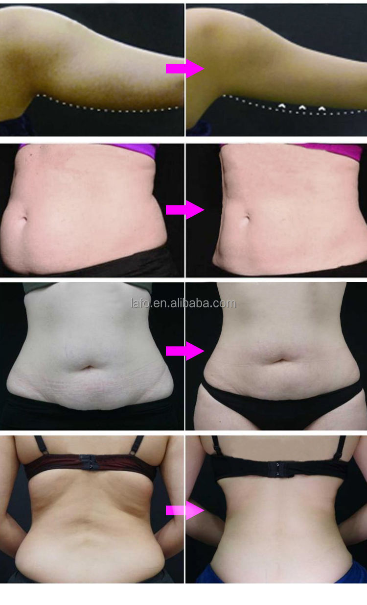 360 Degree Cooling Cryo 2 Handles Cryo Cryotherapy Fat lipolysis Criolipolisis Machine with different cryo cups LF-268A