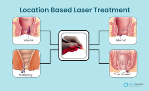 Remoção de Hemorroidas com Ablação de Tecidos Moles 980 1470nm, Tratamento Cirúrgico de Hemorroidas, Máquina EVLA EVLT para Veias Varicosas - Product Image 5