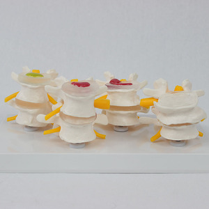 Modèle comparatif de colonne vertébrale lombaire pathologique à 4 étapes ; modèle de squelette humain, modèle pédagogique, fournitures du fabricant. - Product Image 1
