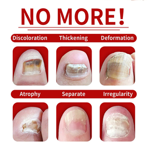 Nhãn hiệu riêng 7 ngày điều trị nấm móng tay tinh chất sử<span class=keywords><strong>a</strong></span> chữ<span class=keywords><strong>a</strong></span> vi khuẩn thô móng đổi màu giòn chăm sóc móng sử<span class=keywords><strong>a</strong></span> chữ<span class=keywords><strong>a</strong></span> tinh chất - Product Image 2