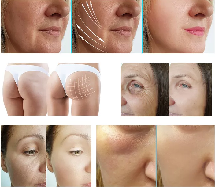 2023 New 8D HIFU Ultrasound Skin Tightening Machine Hifu Therapy For Face And Neck Lifting