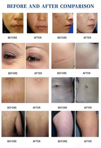 Machine de beauté au laser fractionné CO2 60W pour le resserrement et le resurfaçage de la peau, blanchiment vaginal au laser 980nm, resurfaçage cutané - Product Image 6