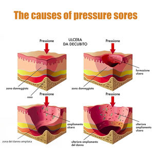 Crème de traitement des escarres la plus vendue pour la guérison des plaies corporelles et pommade anti-infection pour l'élimination des escarres - Product Image 2