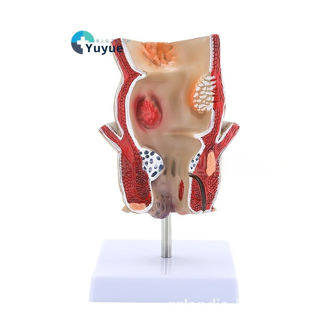 Human Rectum Anatomy Model PVC Medical Science Training Education for Pathological Hemorrhoids Internal External Hemorrhoid