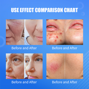 Máquina Facial Profesional de Hidrodermoabrasión 14 en 1 para Spa de Belleza, con Compatibilidad con Enchufes de EE. UU./Australia/UE - Product Image 6