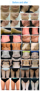 การดูแลกระชับสัดส่วนทั่วร่างกาย สร้างเอวที่กระชับและสะโพกที่ยกกระชับ - Product Image 6