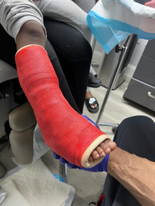 Cinta de Yeso Ortopédica de Fibra de Vidrio para <span class=keywords><strong>Hospital</strong></span>, 15 cm x 4.5 m - Rollo de Férula con Certificación CE ISO13485 para Inmovilización de Fracturas - Product Image 4