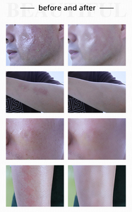 Producto de Tendencia 2026, Equipo de Belleza con Láser Fraccional de Tulio Erbio de 1927nm para Eliminación de Cicatrices No Invasiva, Rejuvenecimiento y Blanqueamiento de la Piel - Product Image 6