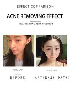 2026 Korean Household Beauty Salon Products - Acne and Pimple Remover Skin Purifier Facial Cleansing Brush - Product Image 5