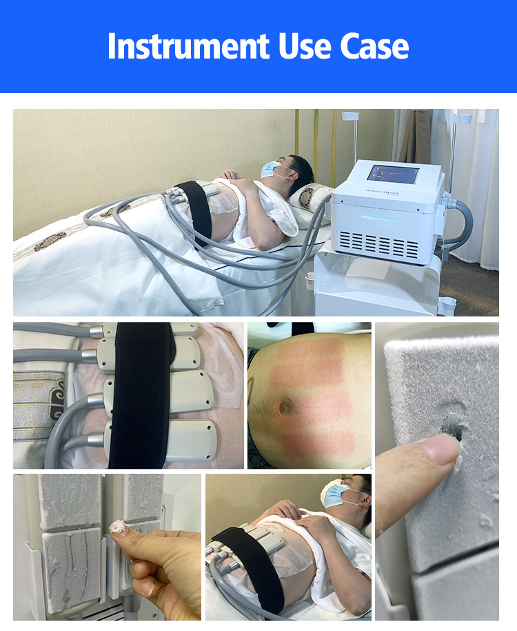 Portable Cryotherapy cooling ems pads, 4 cryolipolysis ems plate freezing slimming machine LF-272