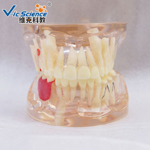 Modelo de Dientes Humanos para Ciencias Médicas, Modelo Patológico de Pérdida Prematura de Dientes Deciduos, Transparente, Mixto con Dientes Faltantes - Product Image 2