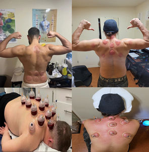 Alat Bekam Medis Transparan Sekali Pakai yang Nyaman, Perangkat Tubuh Tradisional Tiongkok, Disetujui <span class=keywords><strong>CE</strong></span>, Harga Pabrik Langsung - Product Image 6