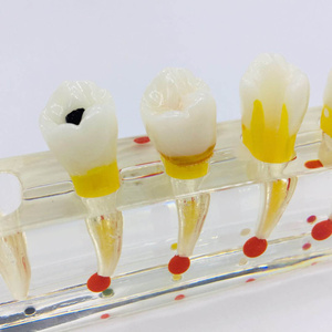 Riparazione della polpa dentale modello orale per la visualizzazione e la comunicazione - Product Image 4