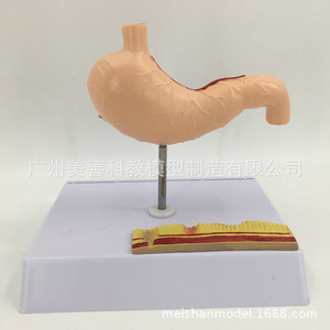 Modelo gástrico patológico en miniatura; modelo gástrico patológico perforado del estómago humano; gastroenterología; coronal - Product Image 2