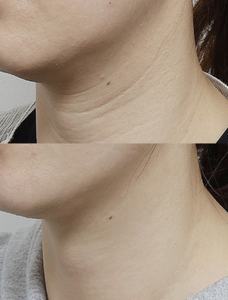 סרום חומצה היאלורונית נגד קמטים, תמצית לחות ומיצוק לעור, סרום לטיפוח עור הצוואר - Product Image 5