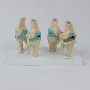 Modello di Articolazione del Ginocchio Malato a 4 Fasi per Educazione Medica con Scheda Posteriore (Materiale PVC) - Product Image 6