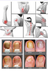 Láser de Podología de Alta Potencia 4 en 1, 60w, 980nm, para Onicomicosis, Tratamiento de Hongos en <span class=keywords><strong>las</strong></span> Uñas, Eliminación de Arañas Vasculares y Capilares - Product Image 6