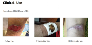 Unidad de Terapia de Presión Negativa para Heridas (NPWT) de Fábrica CE, Tamaño Personalizado, Kit de Apósito para Terapia de Presión Negativa - Product Image 3