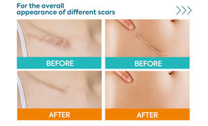 Pommade de gel de <span class=keywords><strong>cicatrice</strong></span> de silicone avancée de prix usine pour éliminer le gel de <span class=keywords><strong>cicatrice</strong></span> de silicone de guérison de peau de cicatrices d'opération - Product Image 4