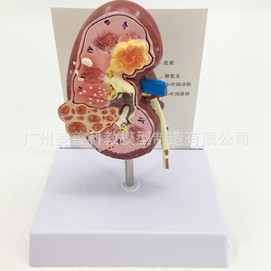 Modelo anatómico de riñón humano, modelo de riñón patológico, especialidad de urología y andrología. - Product Image 5