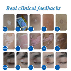 Dispositivo Portátil Certificado <span class=keywords><strong>en</strong></span> EE. UU. con Luz Excimer de 308nm para Tratamiento Localizado de Vitiligo, Solución No Quirúrgica para Vitiligo - Product Image 4